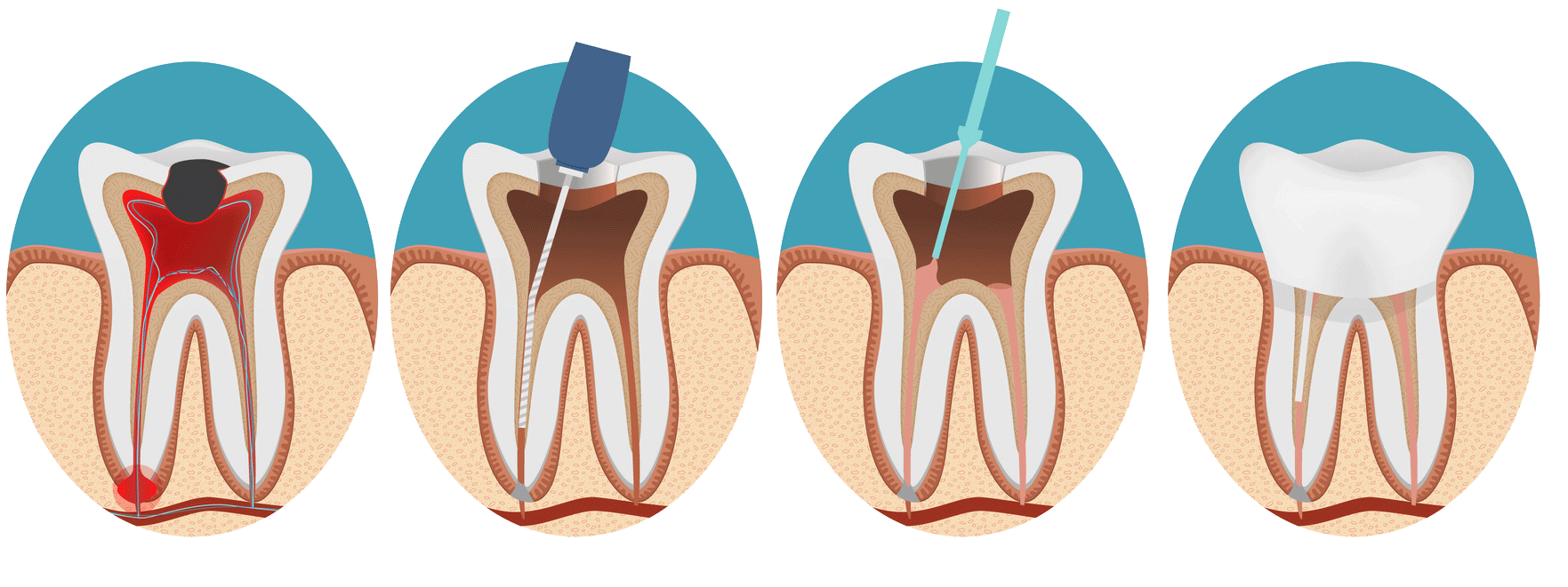 Advantages of root canal treatment - Well Articles
